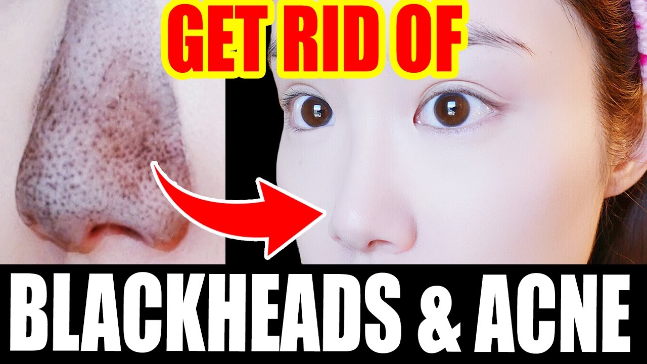 How To: Get Rid of BLACKHEADS at Home! Easy & Affordable