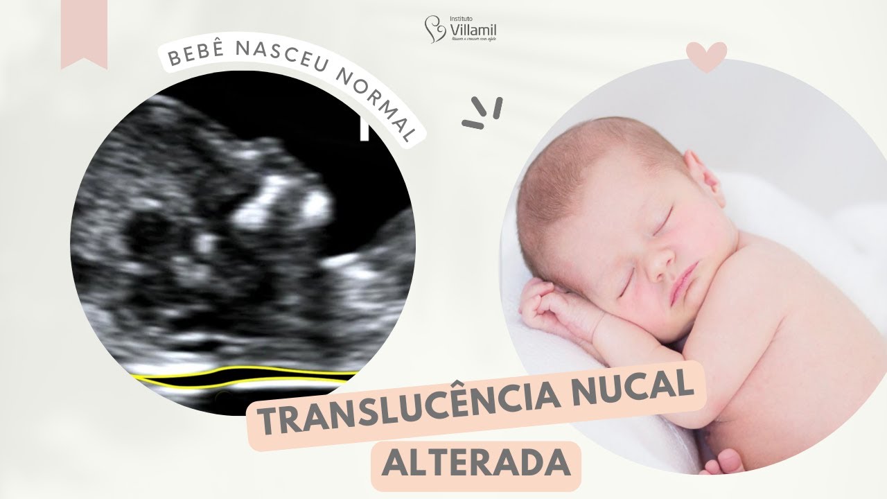 Translucência Nucal Alterada e Bebê Normal | Instituto Villamil #shorts