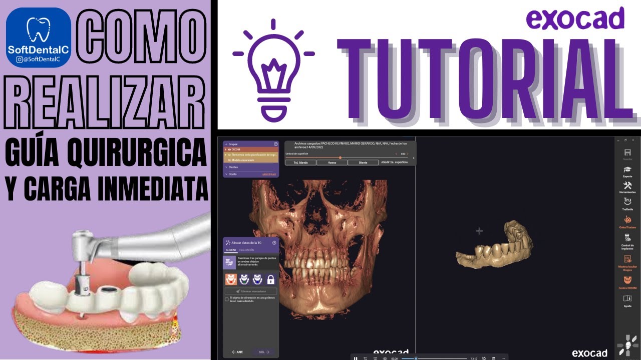 COMO REALIZAR GUIA QUIRURGICA Y CARGA INMEDIATA EN #EXOCAD 🔥¡TUTORIAL SOFTDENTALC!