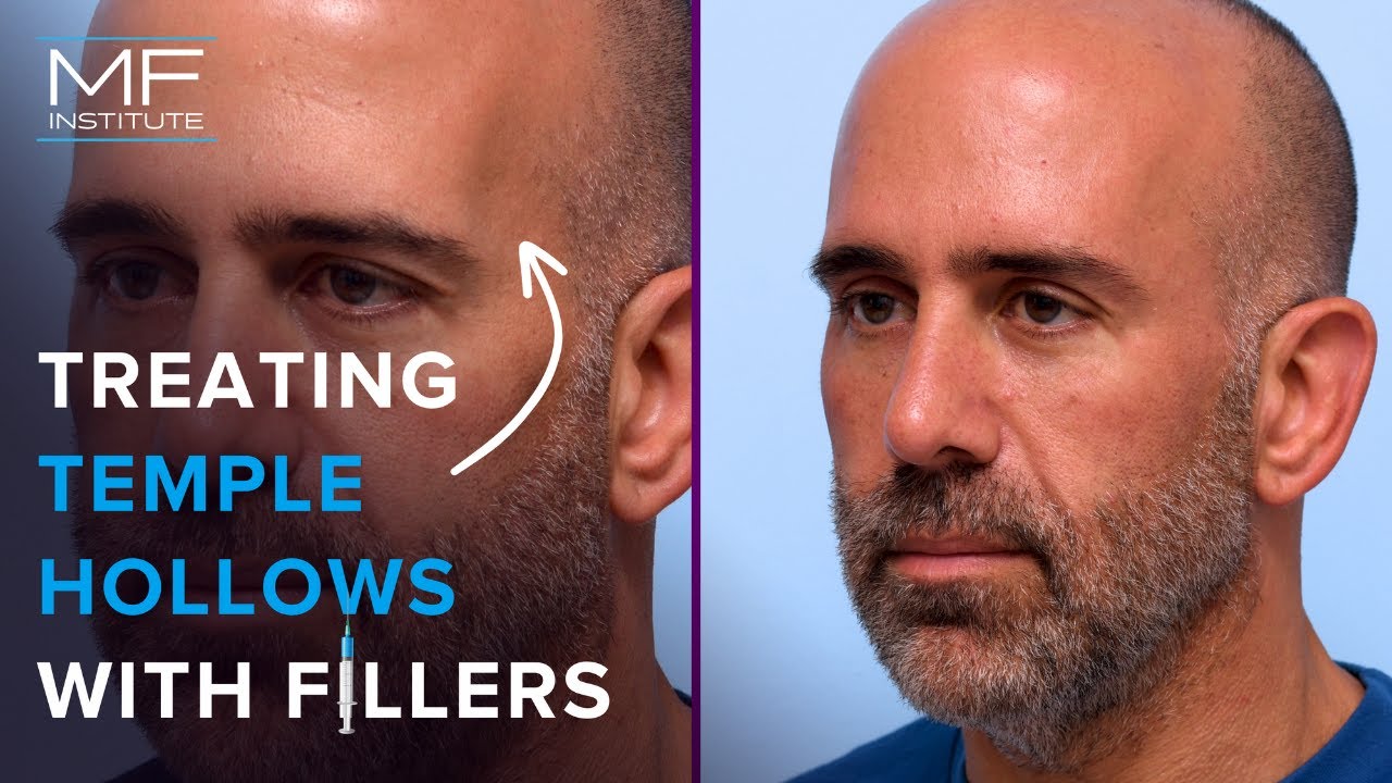 Dermal Fillers For The Temples!? That's Right! | Mabrie Facial Institute in San Francisco, CA