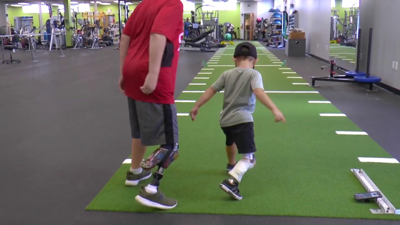 Rotationplasty Amputee Kid Peer Support