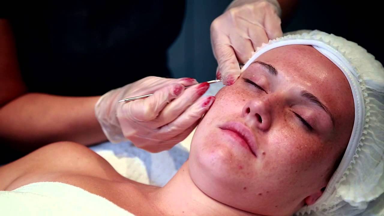 Roxana Pourali's - Milia Removal