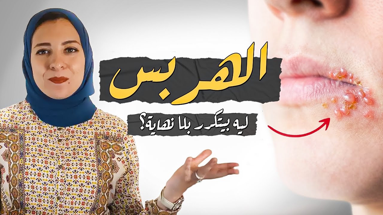 الهربس | الوقاية والعلاج المهم جدا | الاسبتالية