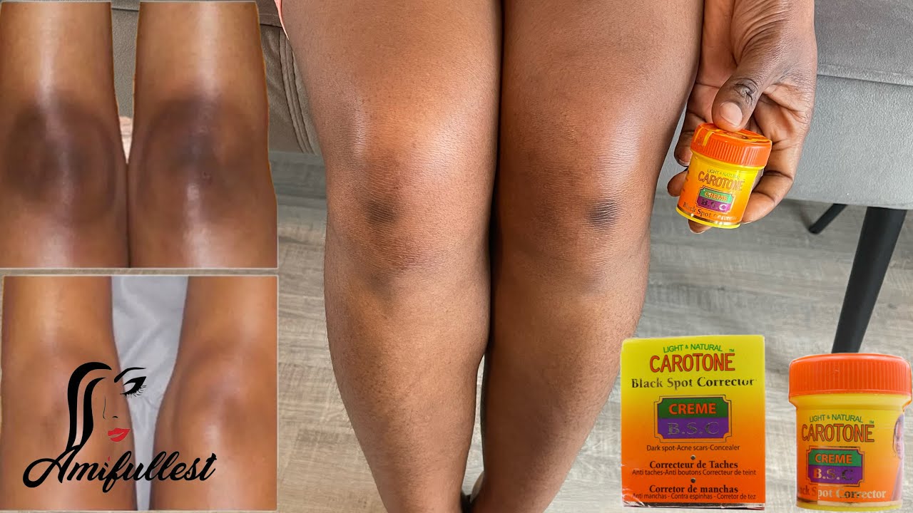 How to lighten your knee | CAROTONE B.S.C | Lighten Dark Elbows, Knees | AMIFULLESTBEAUTY