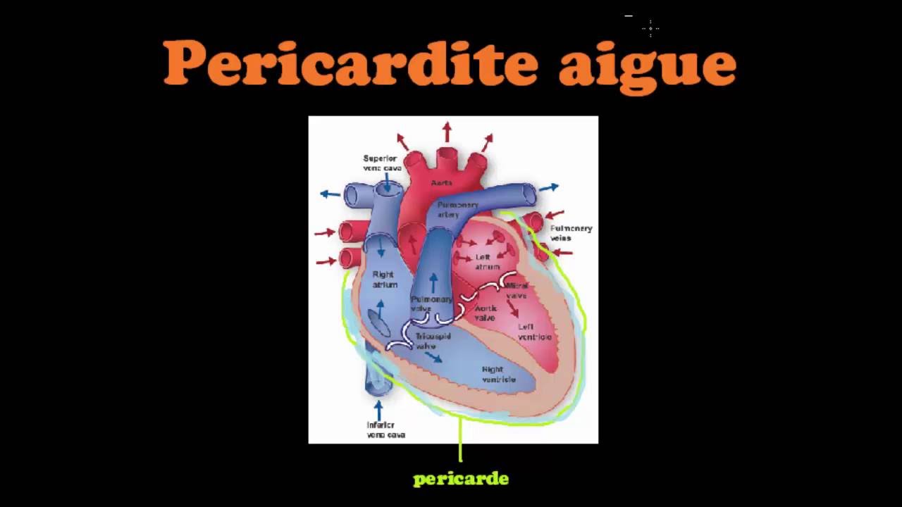 SmartN'Easy Cardio - Pericardite Aigue - Dr Astuce
