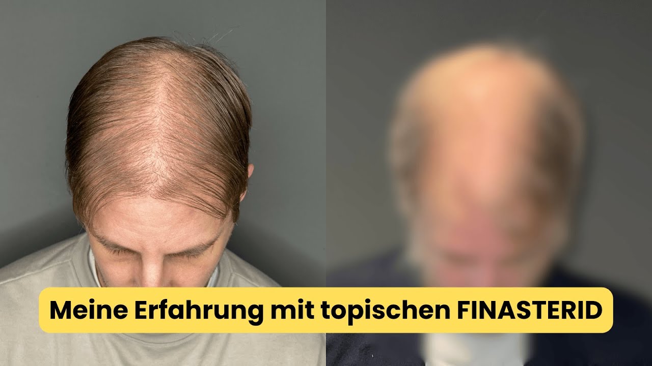 Topisches Finasterid - Meine Erfahrung nach 1 Jahr Anwendung - Haarausfall gestoppt?