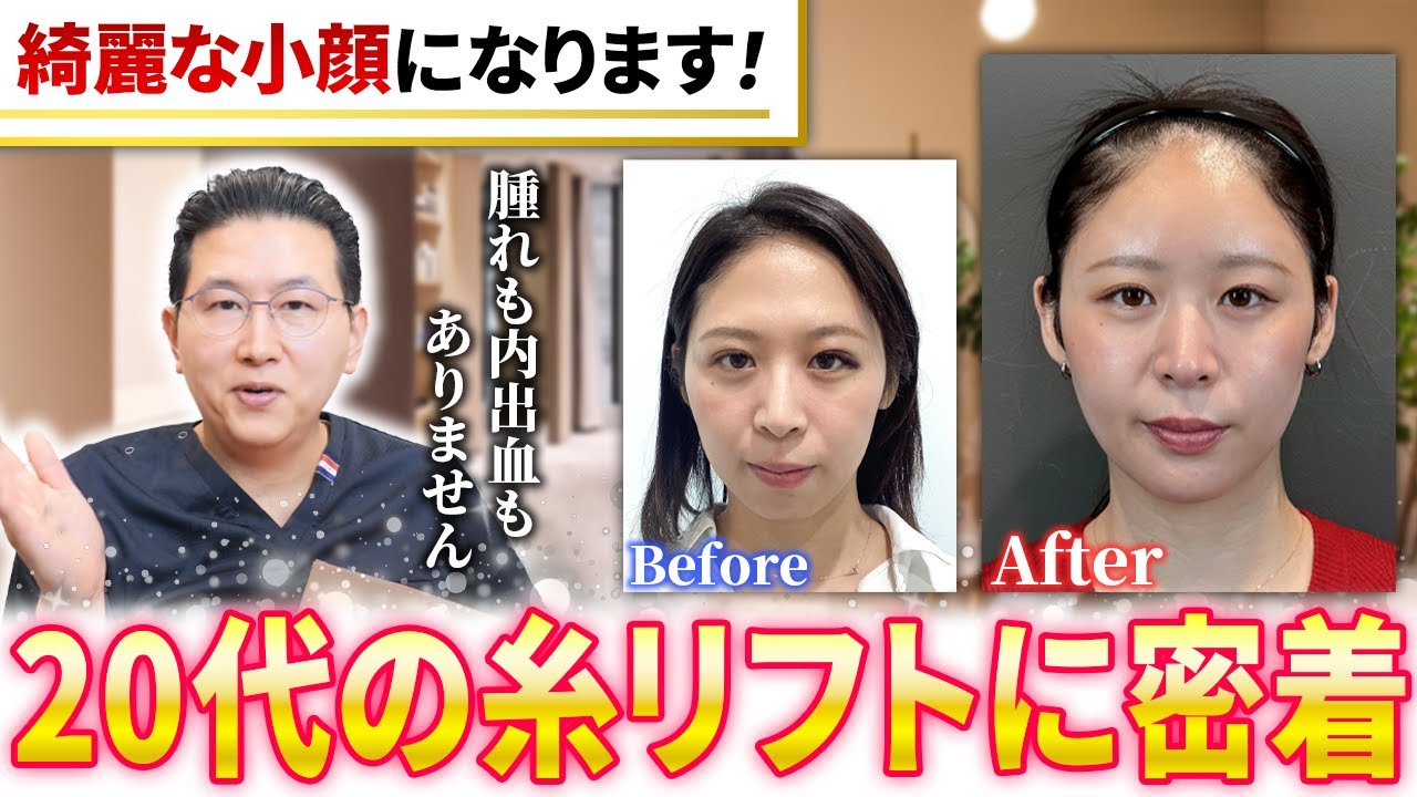 【施術密着】20代で糸リフトは早い？適応と考え方を医師が解説