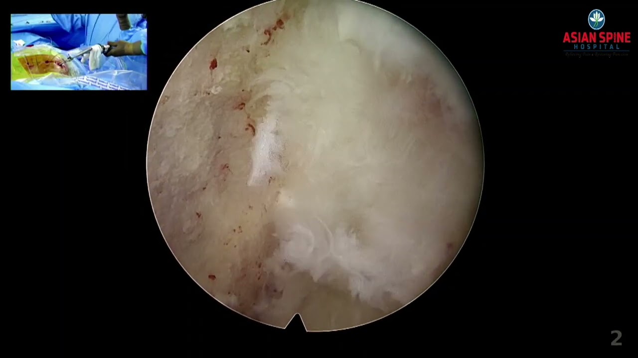 ENDOFUSION (Endoscopic Assisted Trasnsforaminal Transkambian Lumbar Interbody Fusion)