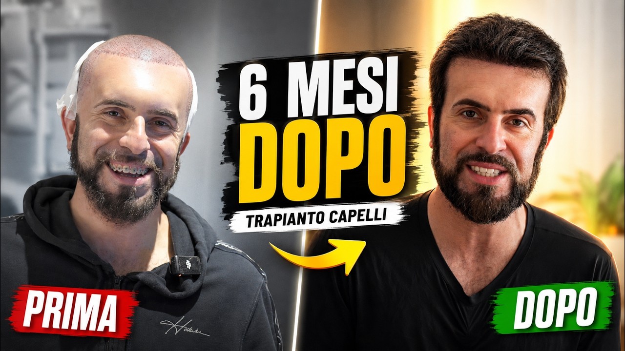 6 MESI DOPO IL MIO TRAPIANTO DI CAPELLI