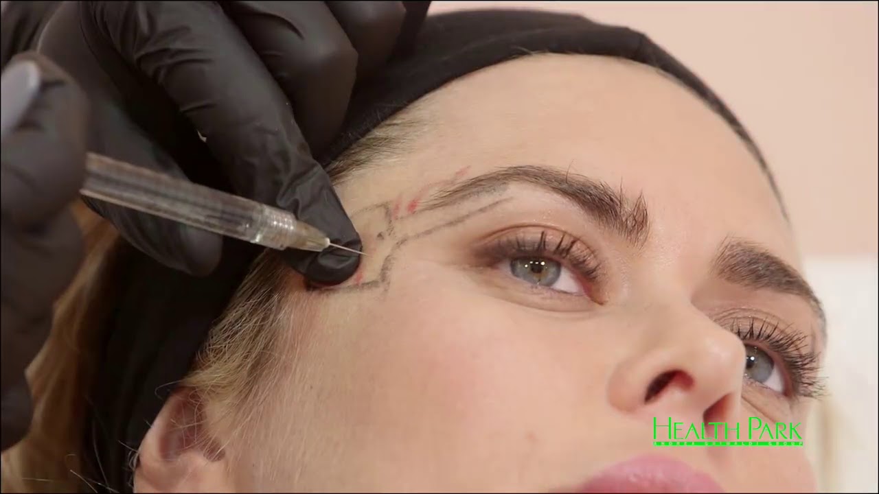 Lifting medico del sopracciglio / Non-surgical Brow lift