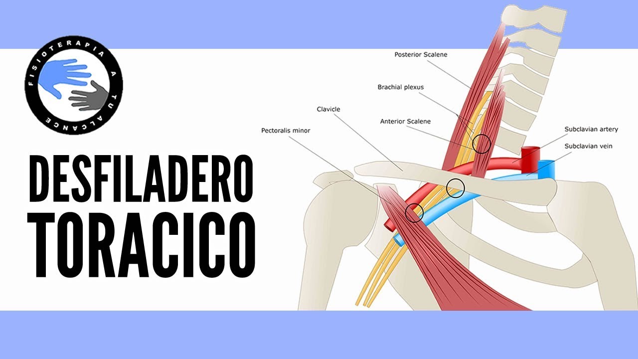Sindrome del desfiladero toracico, que es, por que se produce, diagnostico y tratamiento