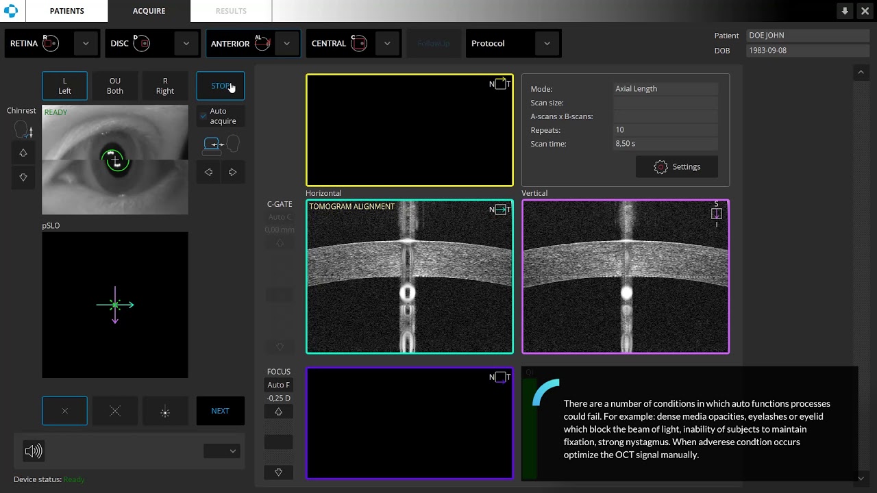 Optopol REVO Biometry OCT Axial Lenght Full Auto Mode 2