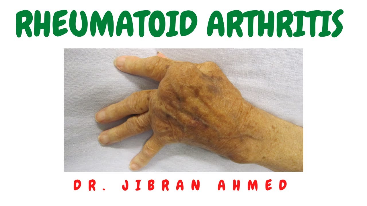 RHEUMATOID ARTHRITIS II BONES AND SOFT TISSUE II ARTHRITIS II ROBBINS 10TH E II PATHOLOGY LECTURES
