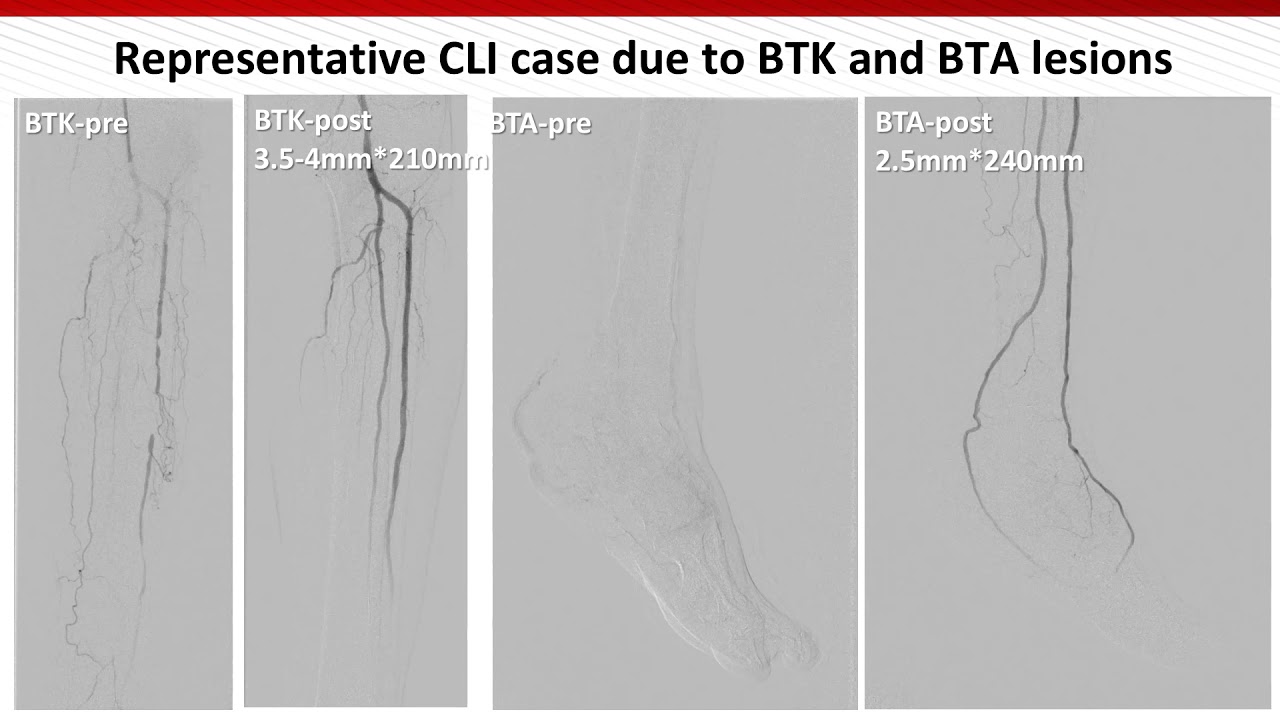 BTK CTO Crossing- Osamu, Iida, MD