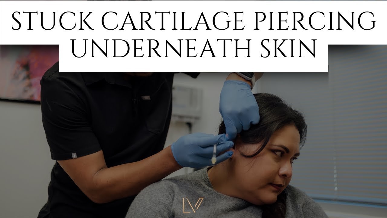 Earring Back Stuck Under Skin #dermatology
