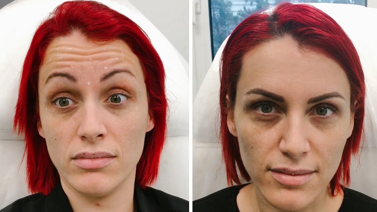 Botox και Υαλουρονικό στα 30;