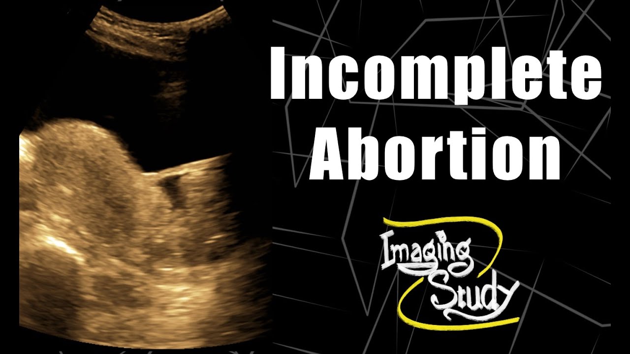 Incomplete Abortion || Ultrasound || Case 79