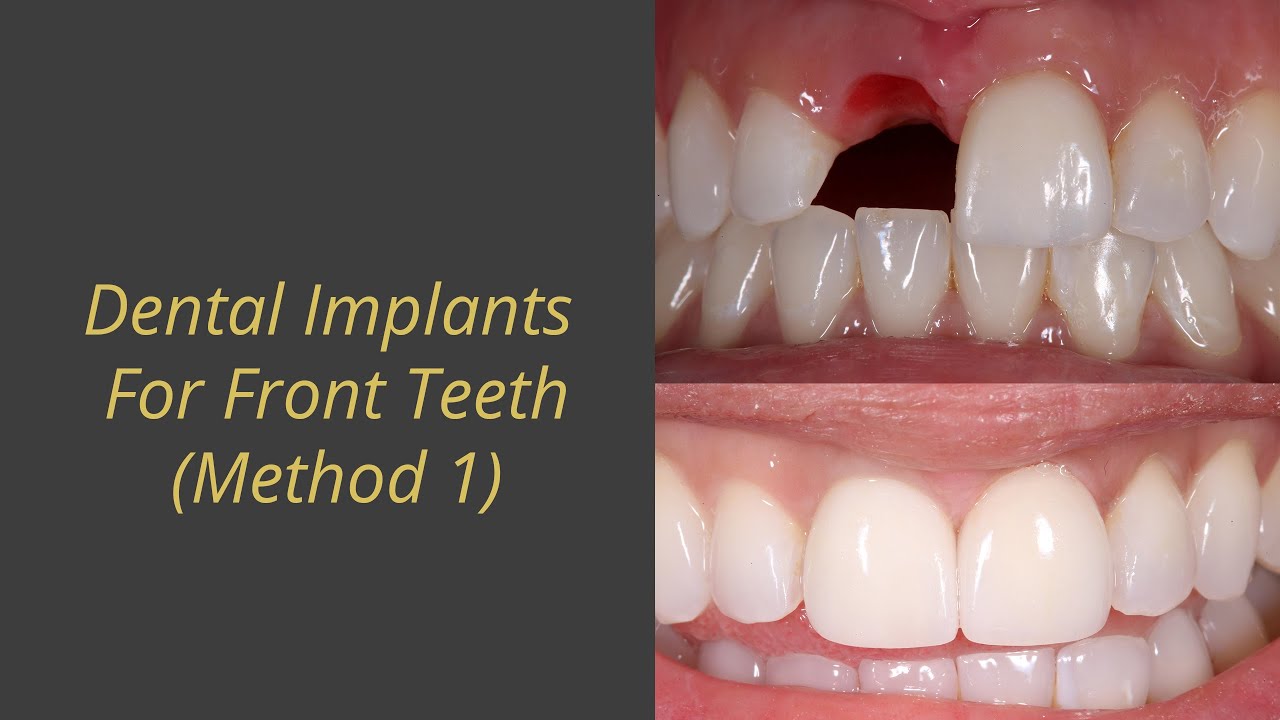 How To Replace Front Tooth With Dental Implants (One way)