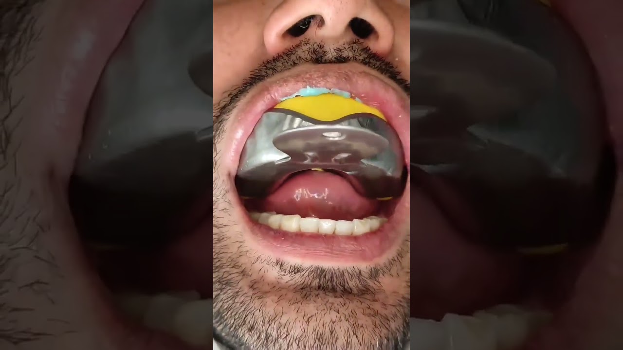Moldagem de Facetas com Silicone de Adição