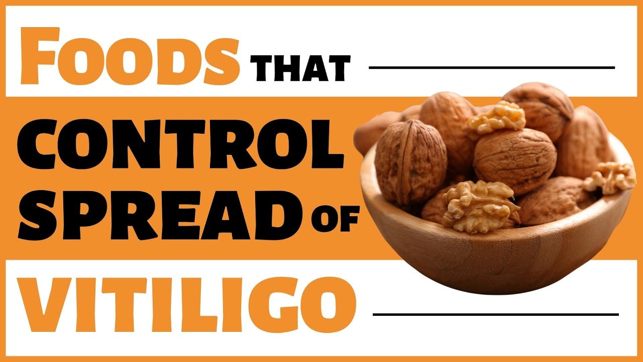 Foods that control spread of Vitiligo | Bharat Homeopathy