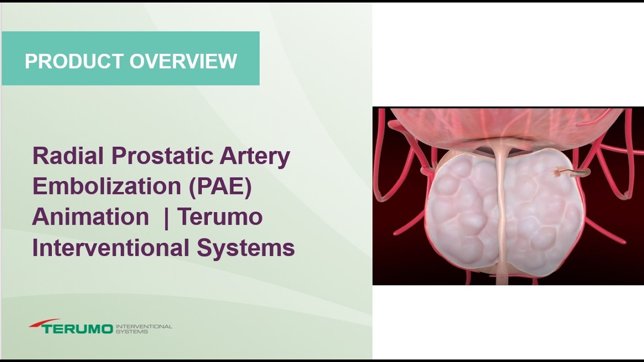Radial Prostatic Artery Embolization (PAE) Animation  | Terumo Interventional Systems