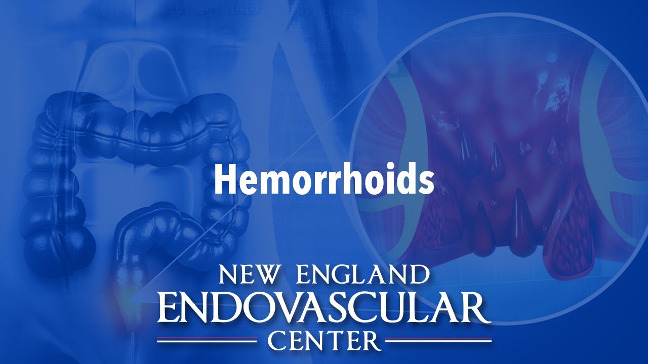 Hemorrhoid Artery Embolization