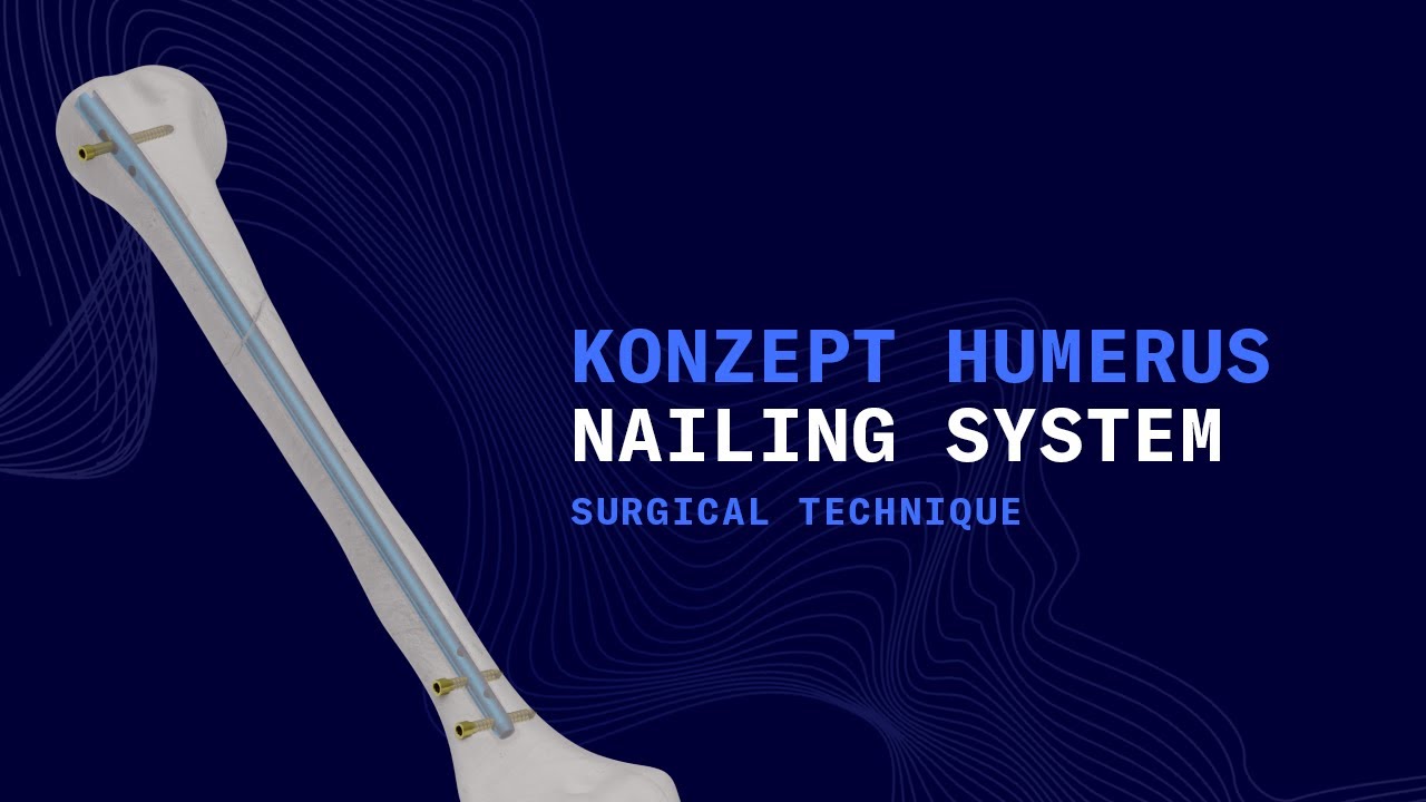 Explore the Konzept Humerus Nailing System by Auxein Medical.