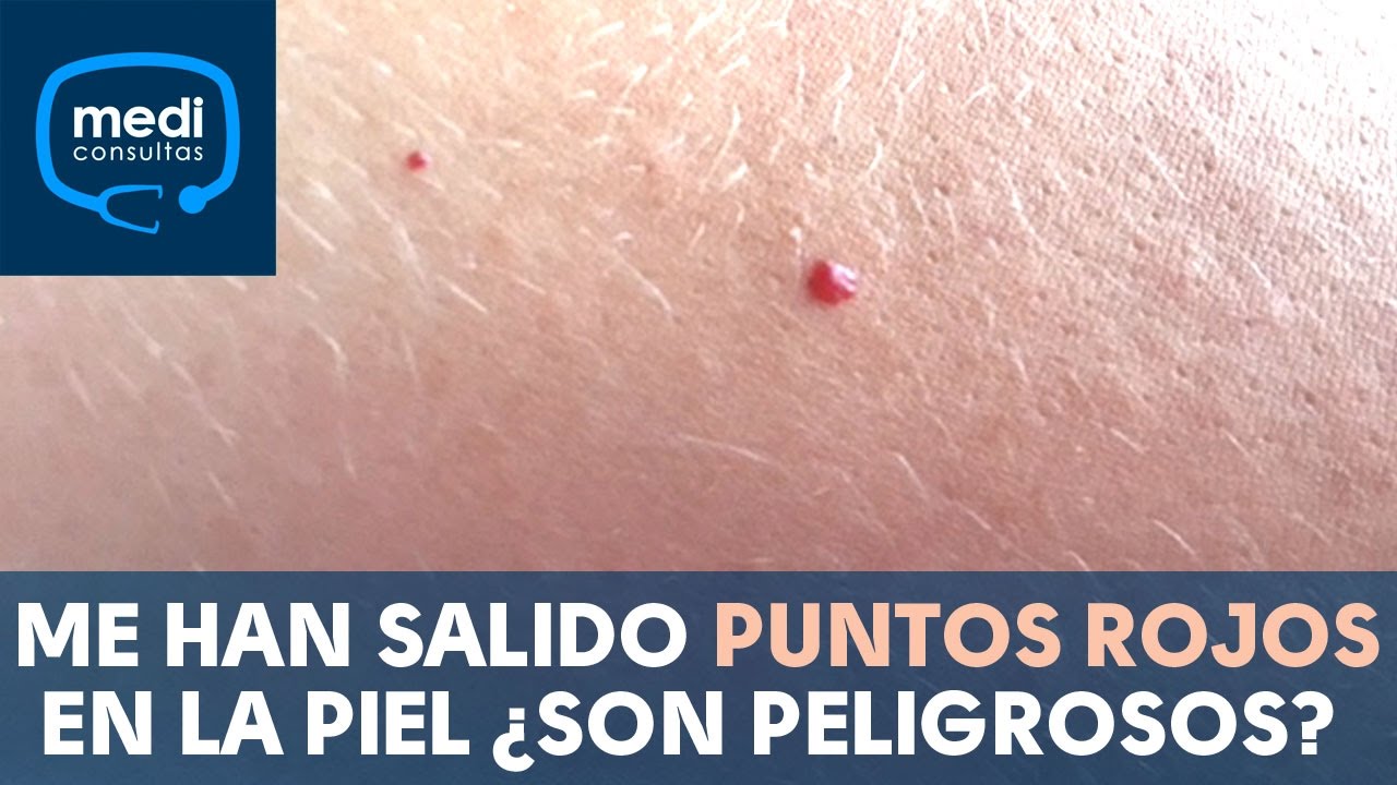 Me han salido puntos rojos en la piel &iquest;son peligrosos? #MediConsultas