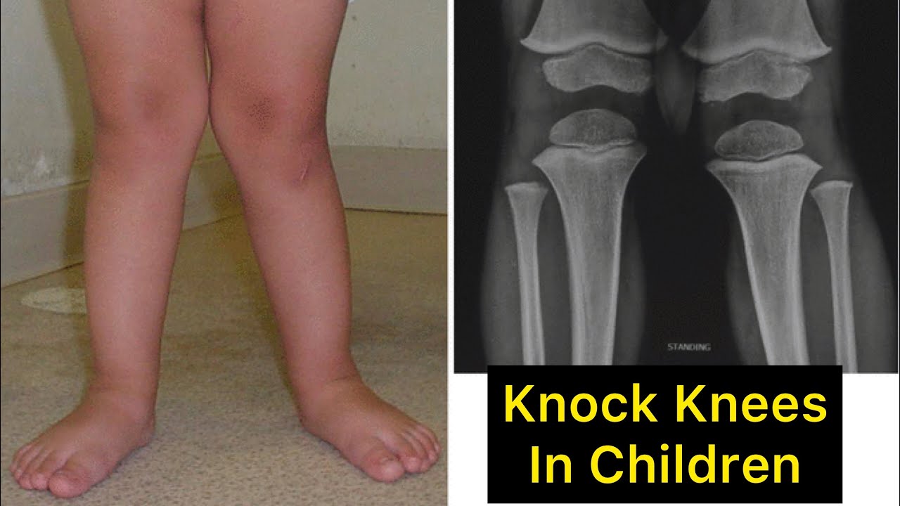 Knock Knees in Children: Correction Exercises