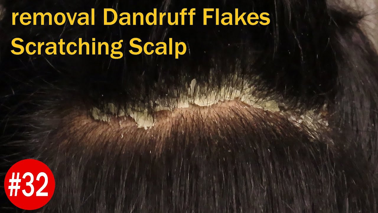 BIG FLAKES | Huge Flakes | removal Dandruff Flakes Scratching Scalp #32