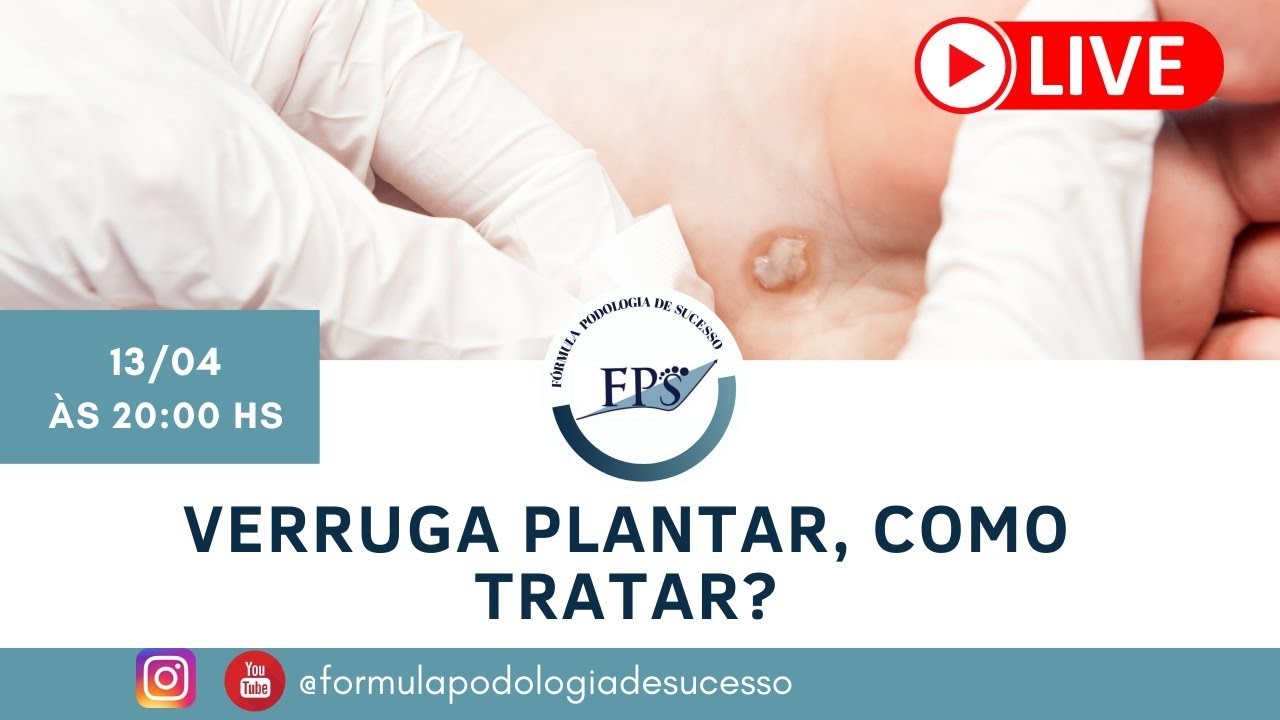 LIVE - Verruga Plantar como Tratar