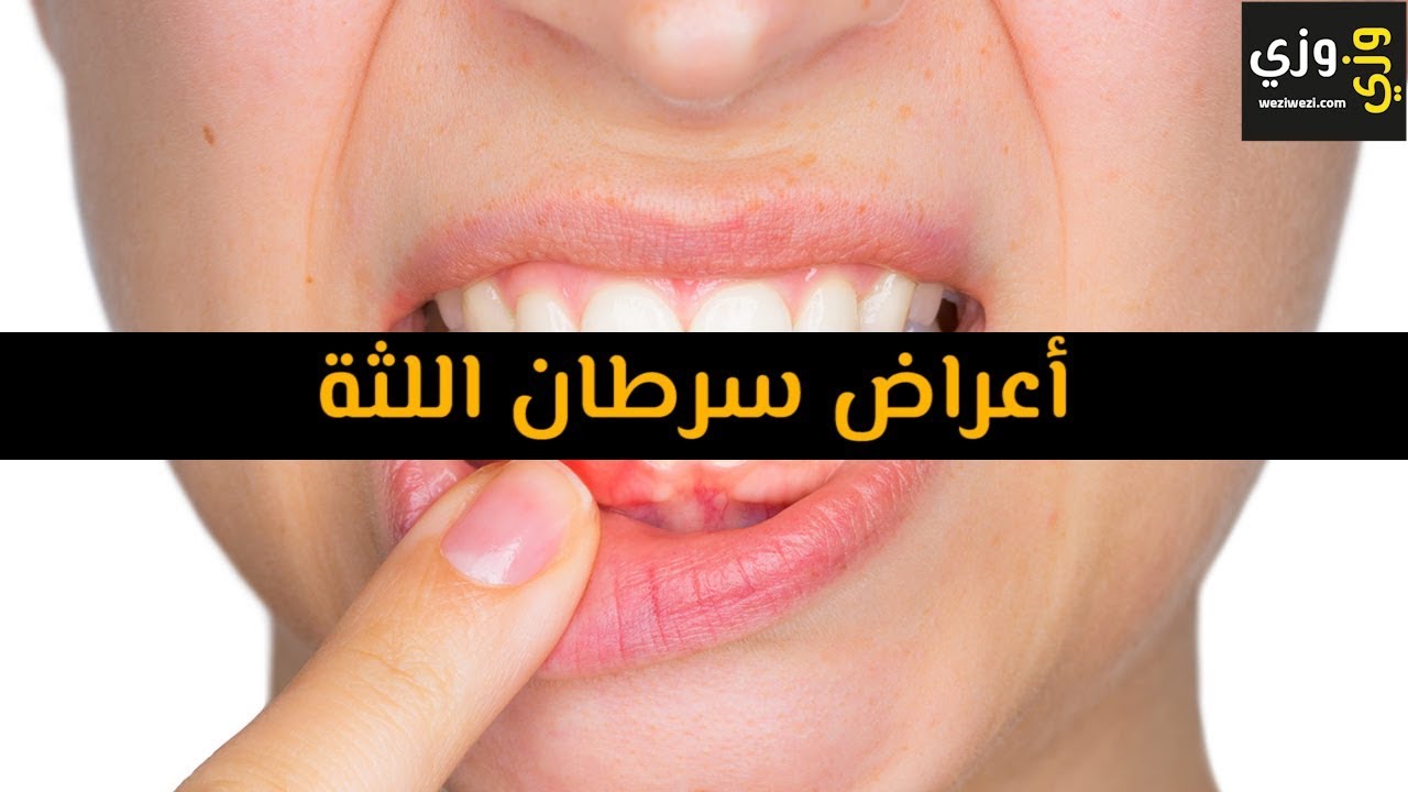 أهم أعراض سرطان اللثة