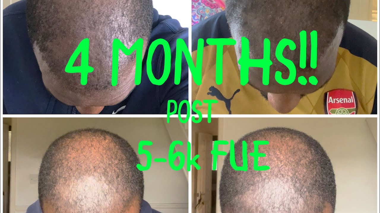 Ep21, 05/04/2022 - 4 MONTHS POST 5-6k FUE HAIR TRANSPLANT @ Asli Tarcan 🇹🇷
