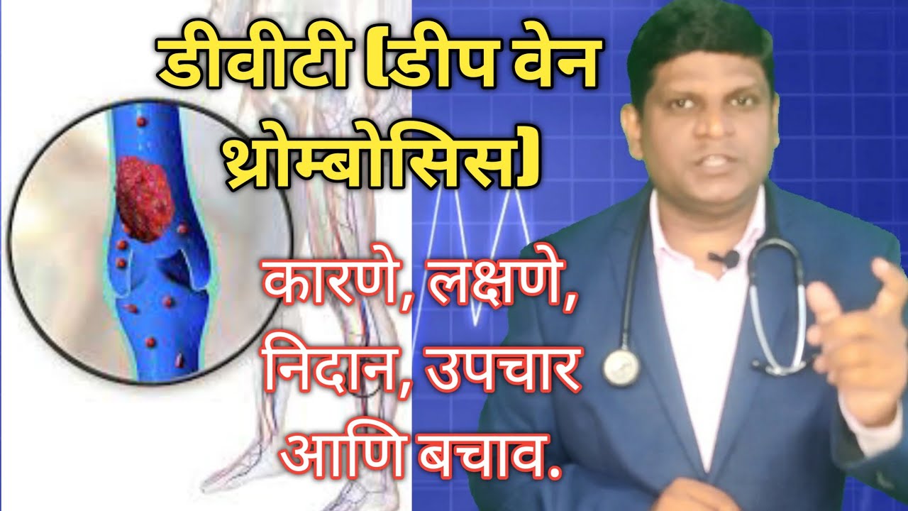 DVT Treatment in Marathi | DVT in Marathi | Deep Vein Thrombosis