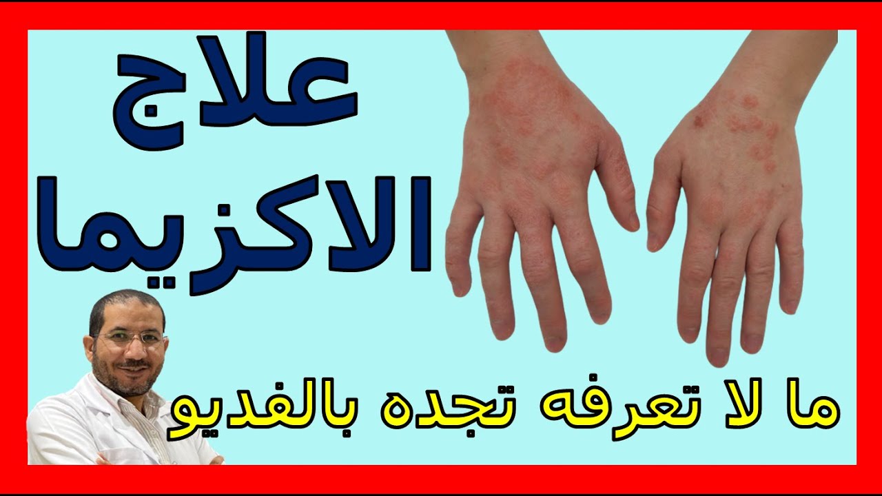 أقوى فيديو عن الاكزيما ما لا تعرفه تجده بالفيديو تشخيص وعلاج