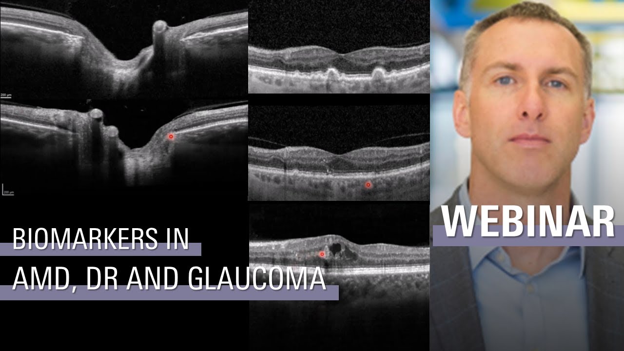 Maximizing SPECTRALIS in the Detection and Interpretation of Ocular Biomarkers | SPECTRALIS