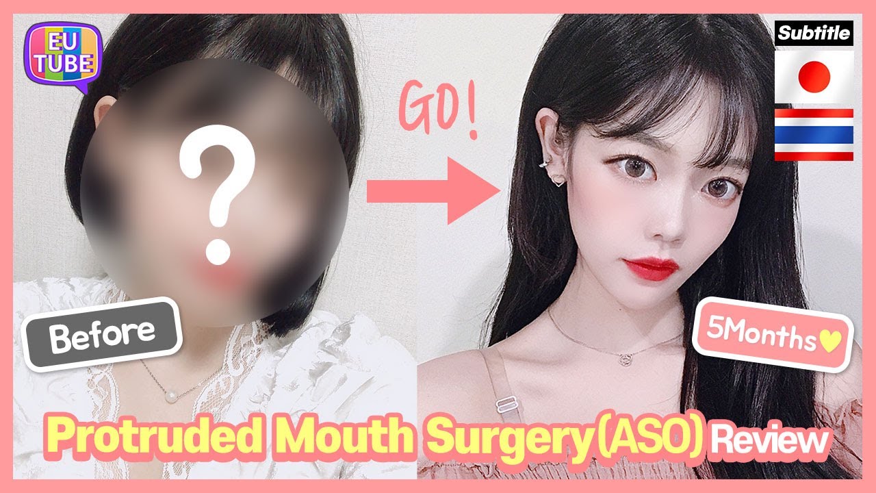 [EN/JP/TH/ SUB] Protruded Mouth Surgery (ASO) Review, Recovery Process 突出口手術 ผ่าตัดปากยื่น