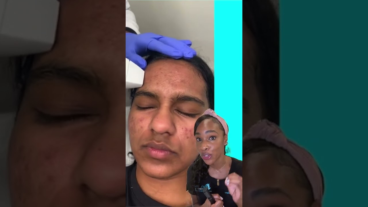 Don&rsquo;t pop your pimples| prevent acne scars