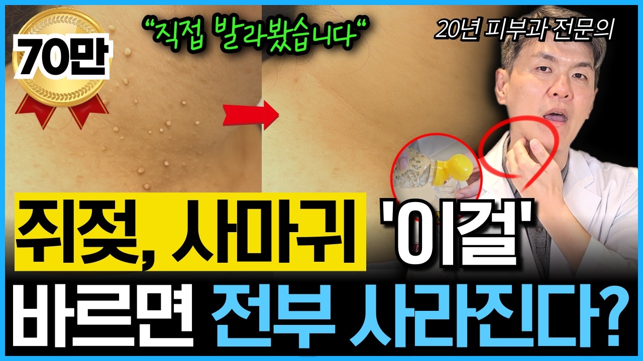 이것 뿌리면 쥐젖, 사마귀 똑 떨어진다? 재발없이 완벽하게 재거하는 방법을 20년차 피부과 전문의가 알려드립니다