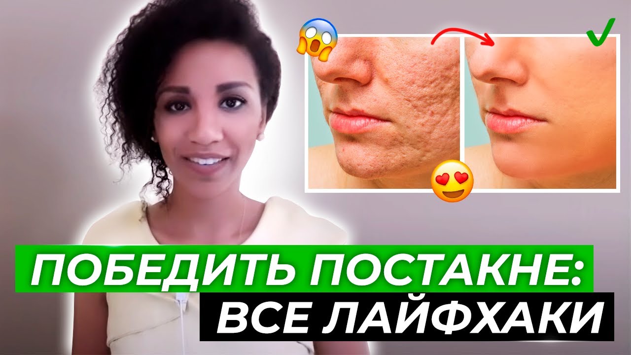 Убрать пятна от прыщей и рубцы постакне: реальная стоимость лечения и самые эффективные способы