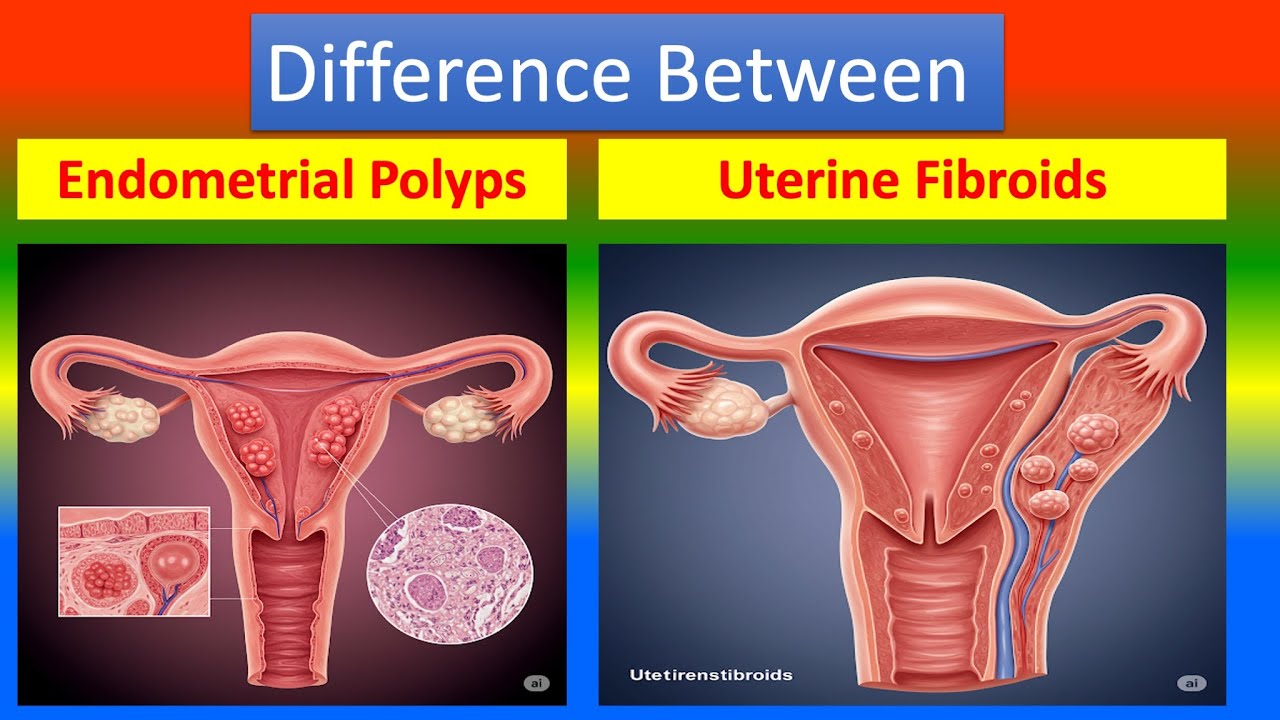 Differance between endometrial polyps and uterine fibroids