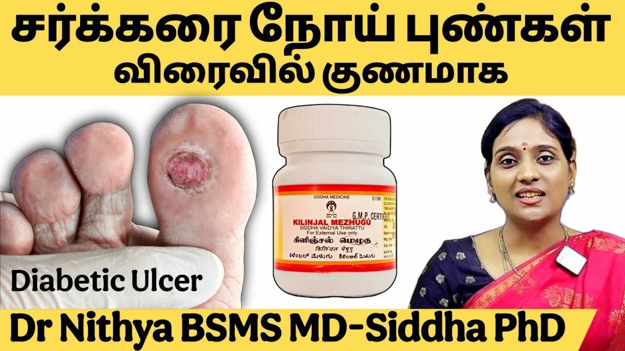 கால் பாத புண்கள்/டையாபட்டிக் புட் அல்சர்/சர்க்கரை வியாதினால் உண்டாகும் புண்கள் குணமாக/Diabetic Ulcer