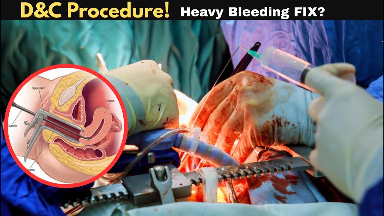 D&C Procedure Explained: Why It&rsquo;s Done, How It Works & Risks #gynecology #womenshealth #uterushealth