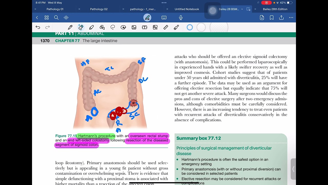 Hartmann's Procedure