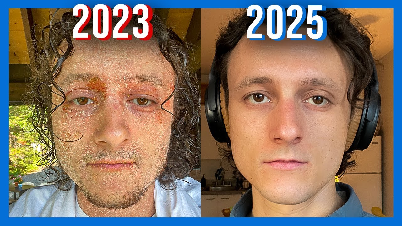 I survived the most painful skin condition. This is what I learned…