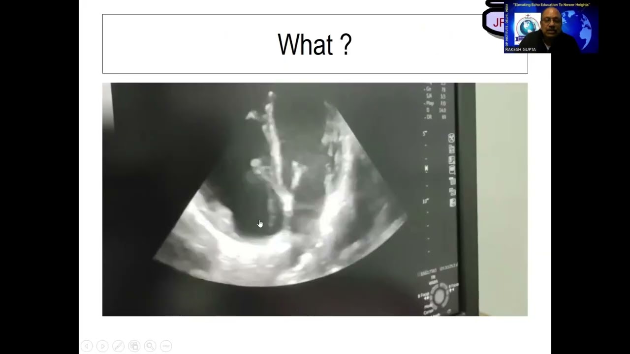 52nd 10th Session- Tricuspid Regurgitation  Pulmonic Regurgitation. How to do it? by Dr Rakesh Gupta