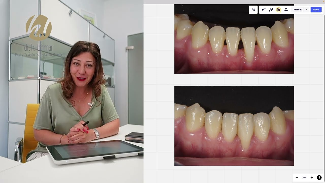 Komposit Veneering: Case Study Black Triangles, Schwarze Dreiecke zwischen den Zähnen