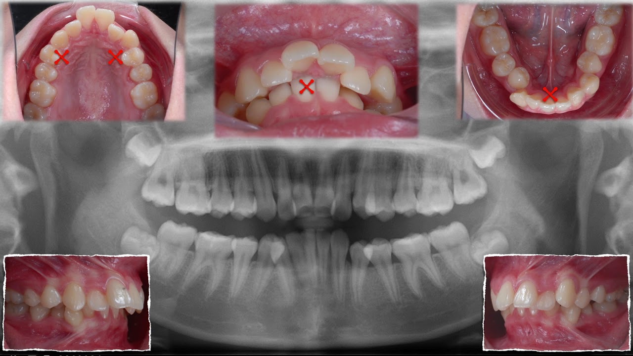 Chris' Top 11 Cases: 4. Class II, Excessive Overjet and Deep Bite｜【Chris Chang Ortho】CC456