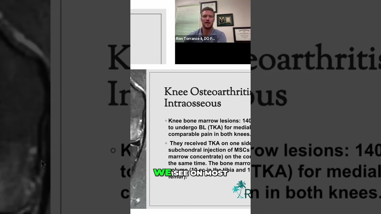 Avoid Knee Replacement: Bone Marrow Concentrate Injections #shorts