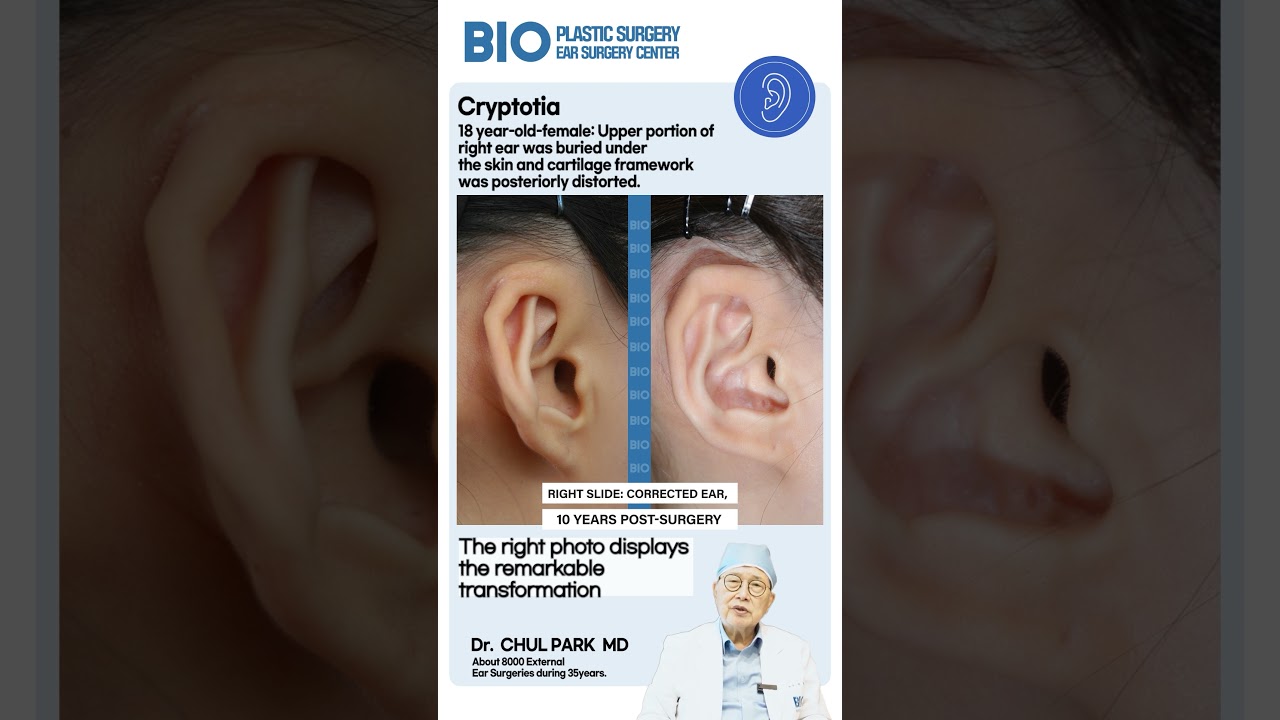 18 year-old-female: #Cryptotia #HiddenEar #EmbeddedEar  #earreconstructionsurgery #earrepair